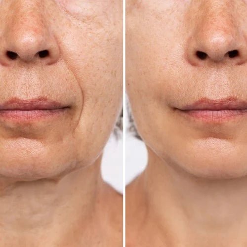LIROMA GLOW® LED - Lichttherapie Gezichtsmasker met Infrarood & Rood licht - Liroma